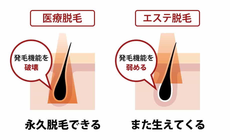 医療脱毛、エステ脱毛