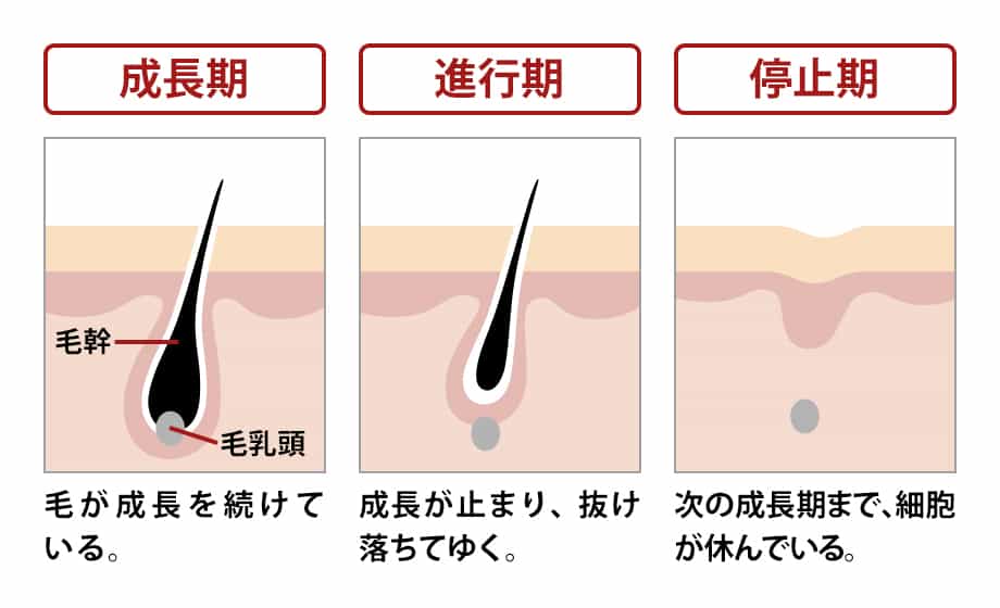 医療レーザー脱毛機