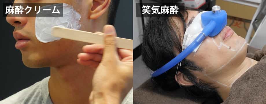 麻酔クリーム、笑気麻酔