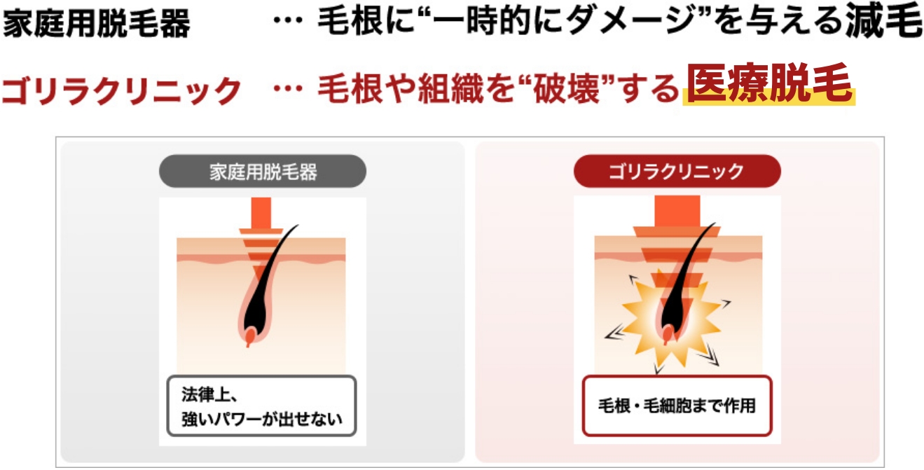 家庭用脱毛器…毛根に”一時的にダメージ”を与える減毛 ゴリラクリニック…毛根や組織を”破壊”する医療脱毛”