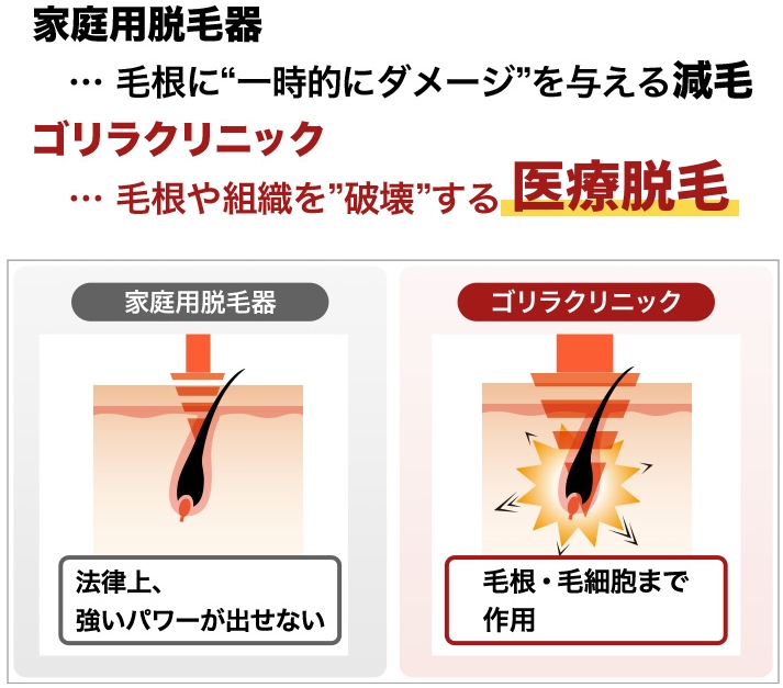 家庭用脱毛器…毛根に”一時的にダメージ”を与える減毛 ゴリラクリニック…毛根や組織を”破壊”する医療脱毛”