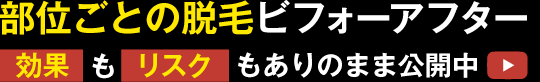 部位ごとの脱毛ビフォーアフター 効果もリスクもありのまま公開中